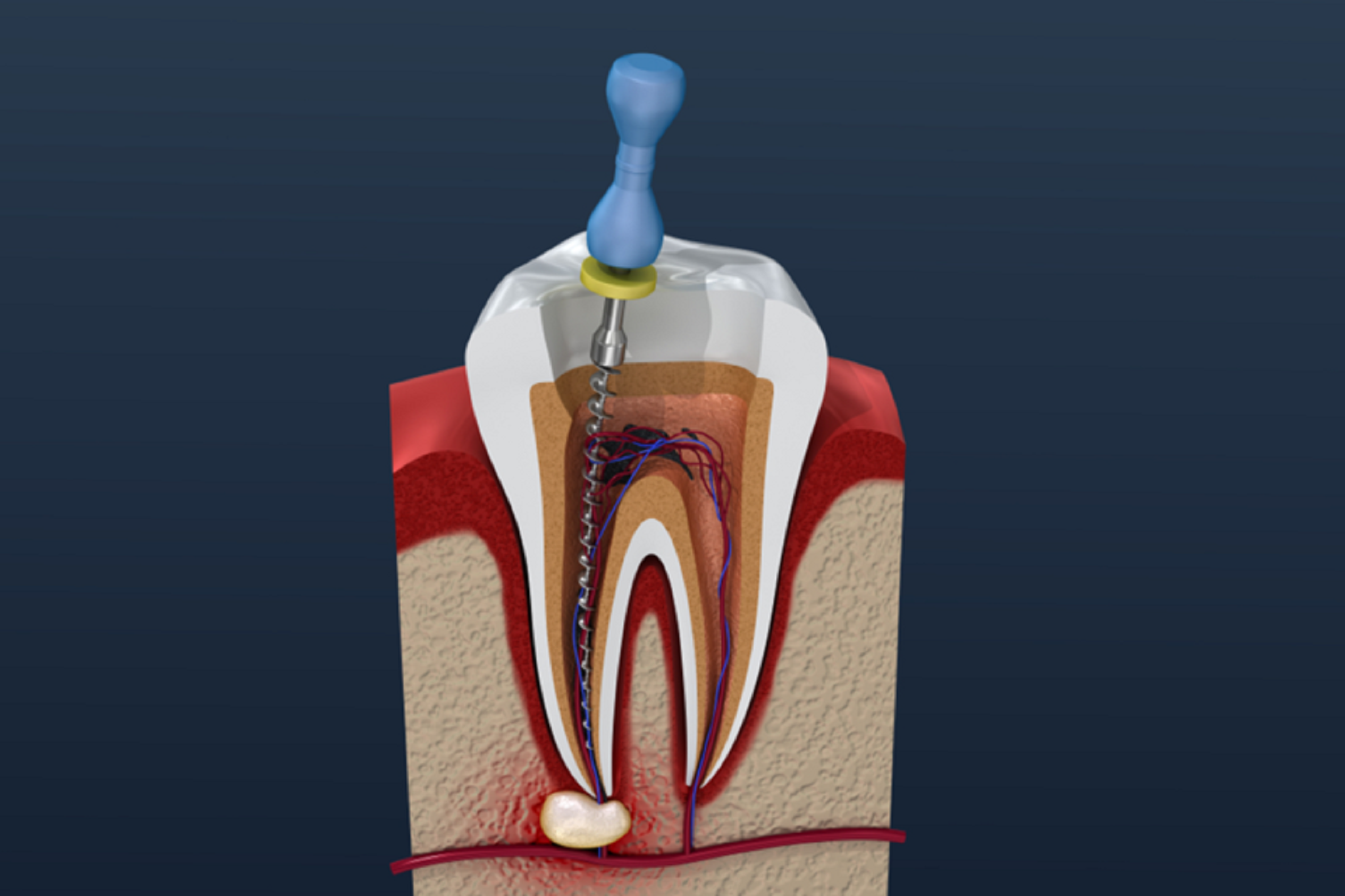 Root Canal Treatment in Blackfalds near Red Deer