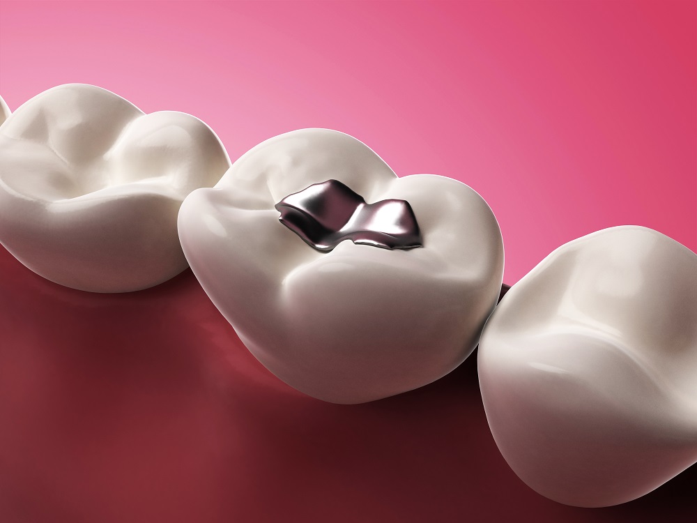 Everything You Need To Know About Dental Fillings