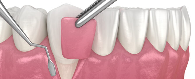 What Are the Different Types of Gum Grafts?