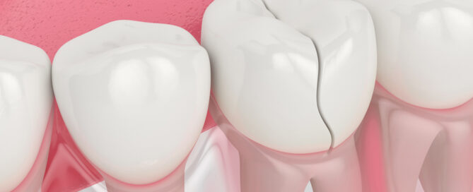 What to Do If You Chip or Break a Tooth?