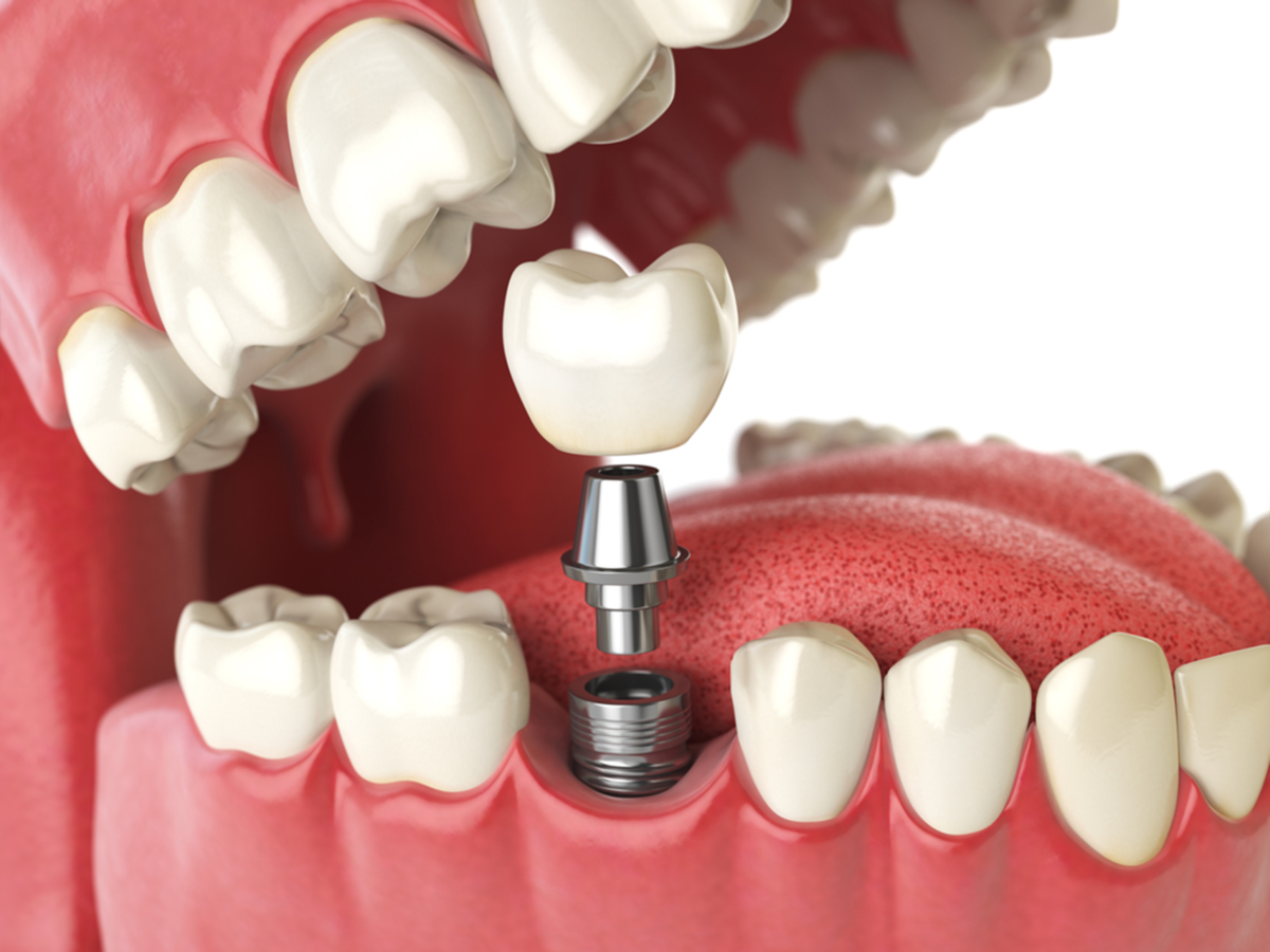 dental implant near you