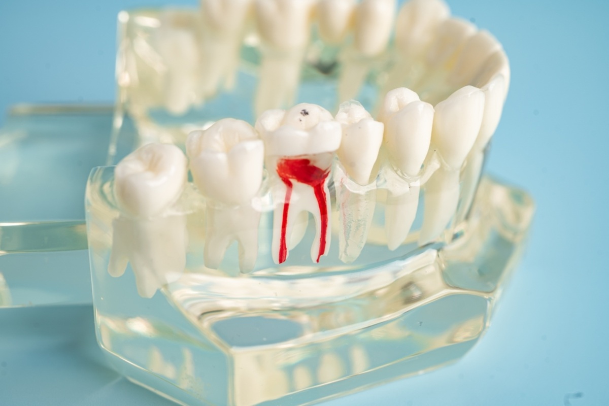 Root canal treatment: why a convenient local option matters